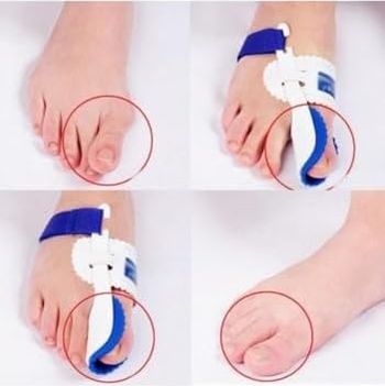 Diğer 57858324454589799283959 Ayak Baş Parmak Kemik Çıkıntı Düzeltici Hallugs Valgus 1 Çift Açık Bej